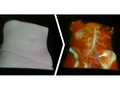 [Projection Mapping for In-Situ Surgery Planning by the Example of DIEP Flap Breast Reconstruction]