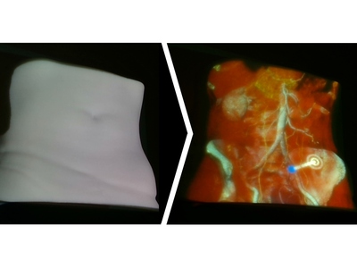 [Projection Mapping for In-Situ Surgery Planning by the Example of DIEP Flap Breast Reconstruction]
